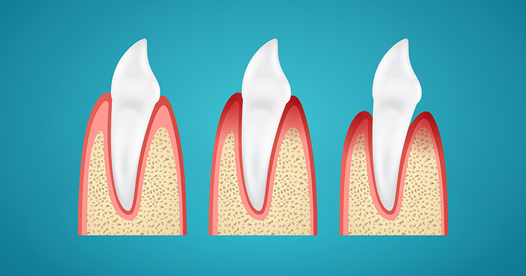 Stages progress disease gum on human canine