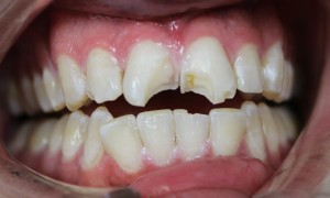 Emergency fractured teeth Before