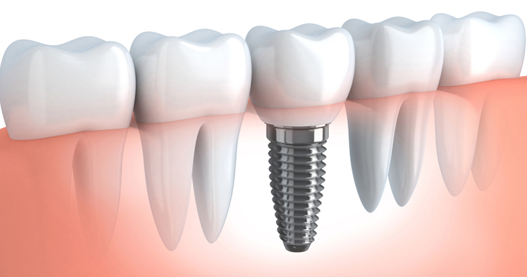 Dental implant